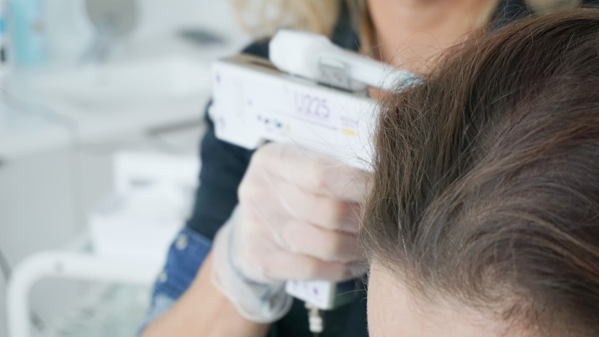 chute de cheveux alopescie Vannes mésothérapie