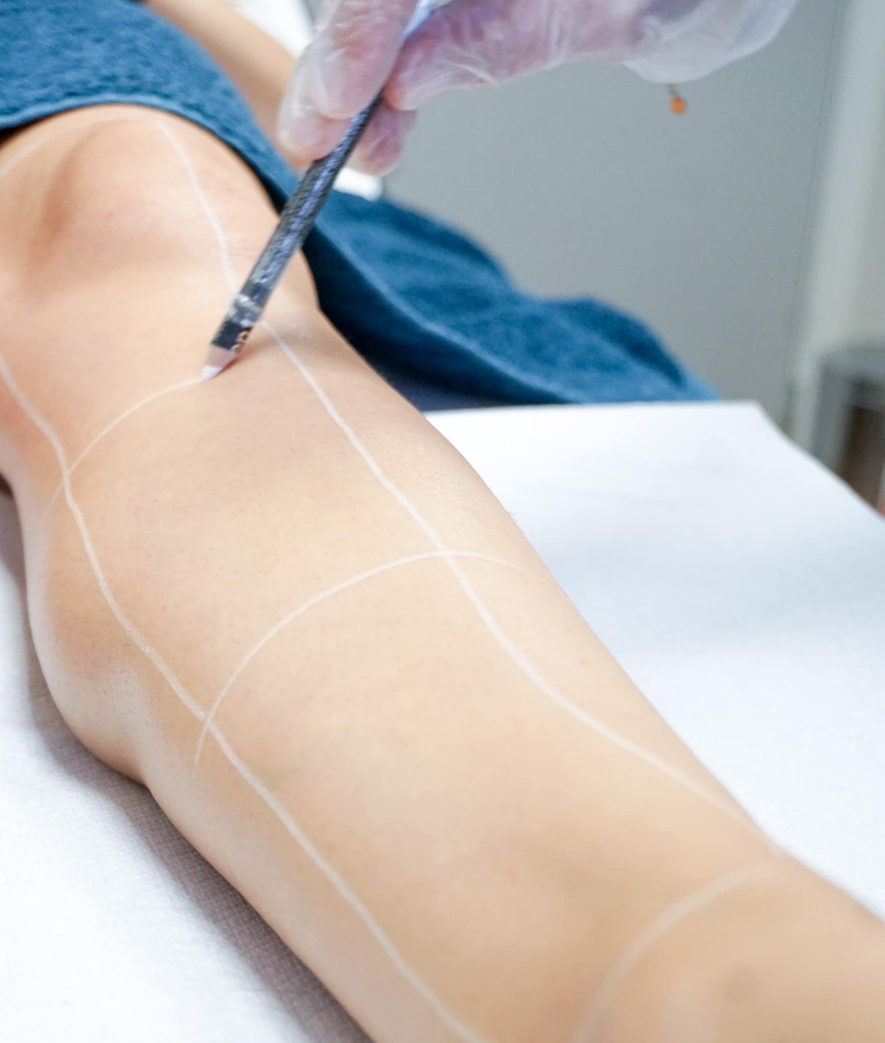 epilation laser vannes
