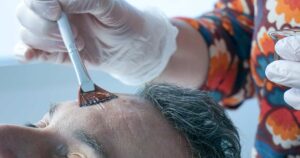 Peeling en médecine esthétique chez CLEM de Vannes