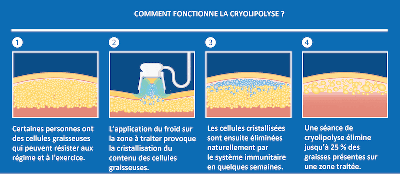 cryolipolyse CLEM VANNES