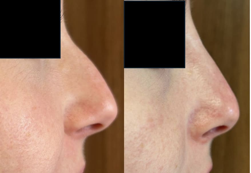 rhinoplastie - docteur BELLECROIX CLEM Vannes