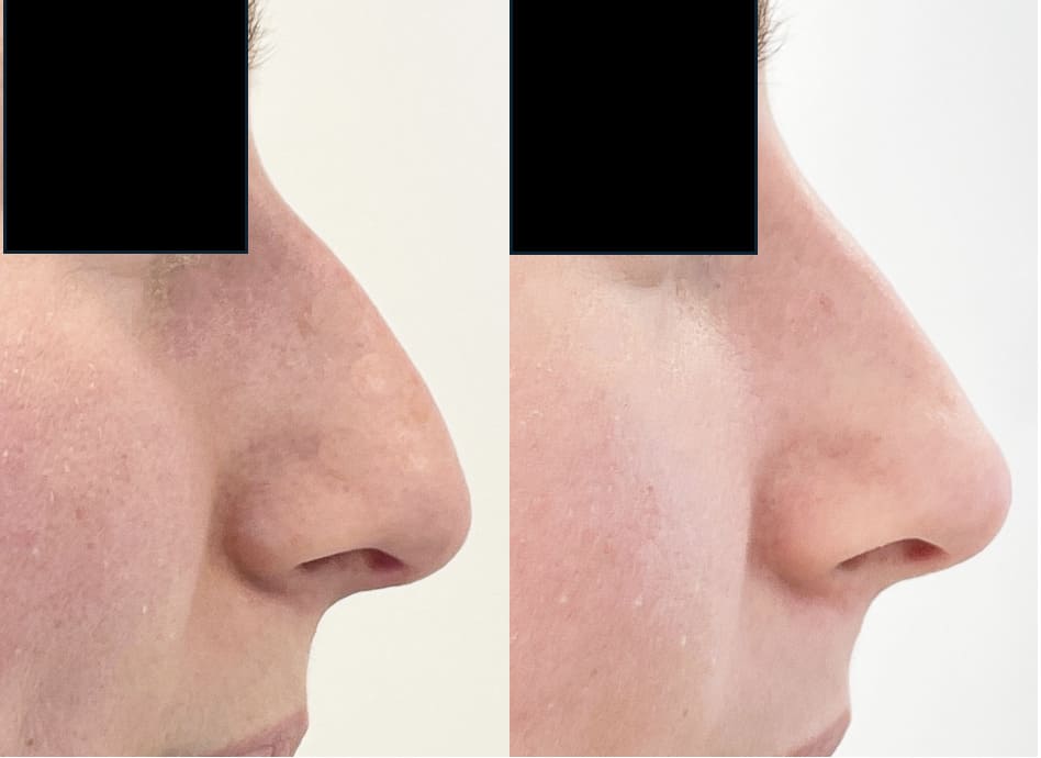 rhinoplastie - docteur PILLETTE CLEM Vannes 2