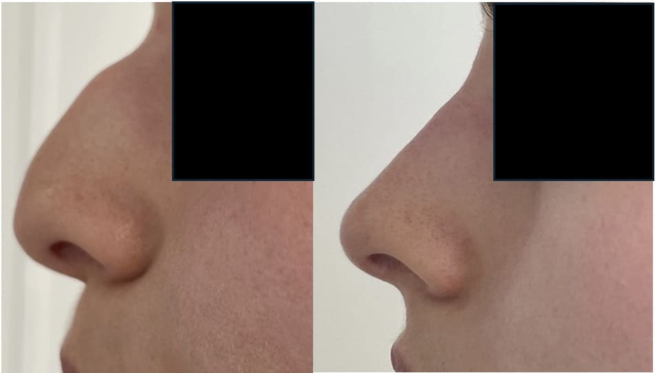 rhinoplastie - docteur PILLETTE CLEM Vannes