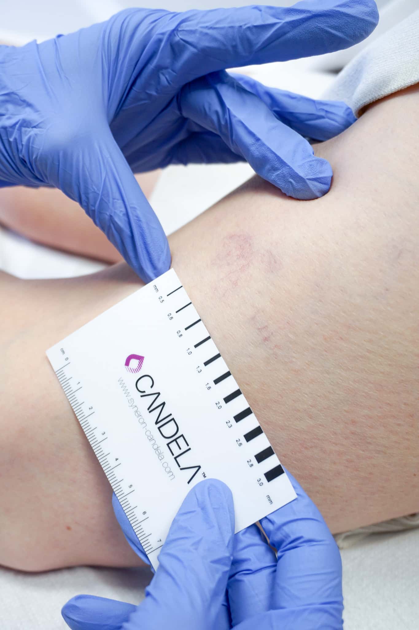 Laser vasculaire