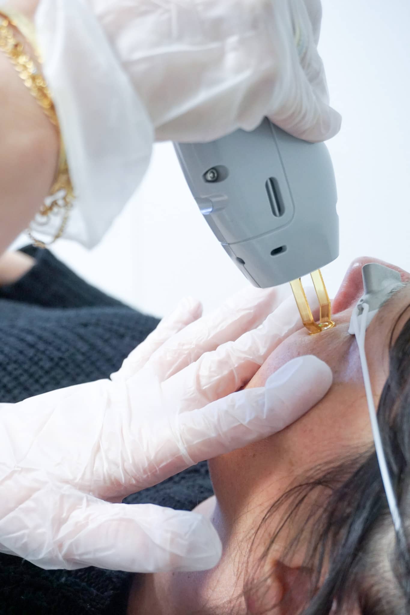 laser vasculaire
