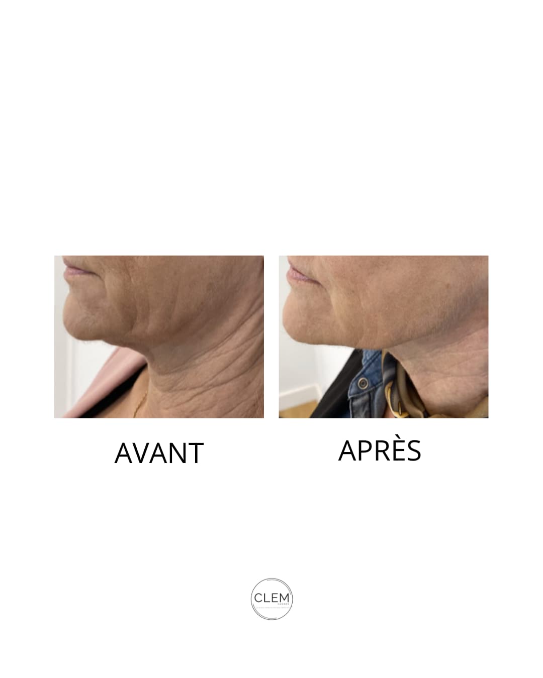 FILS TENSEURS