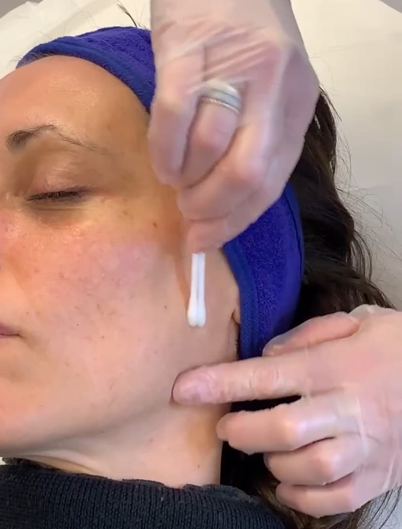 peeling peeling