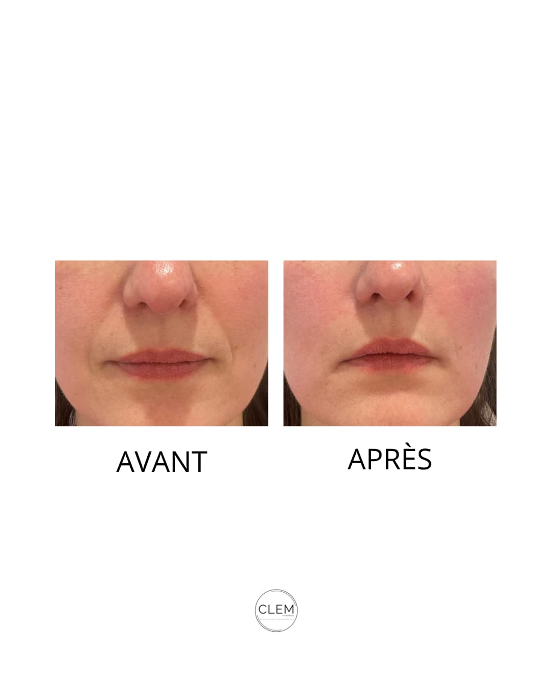 INJECTIONS (1)
