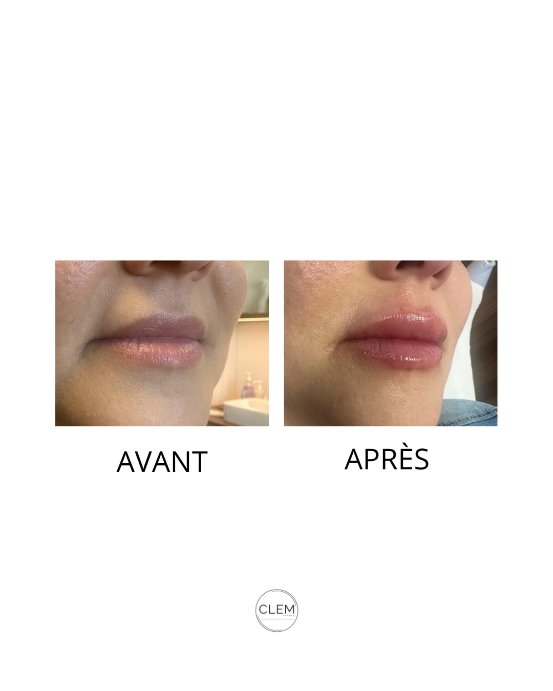 INJECTIONS LEVRES VANNES levres