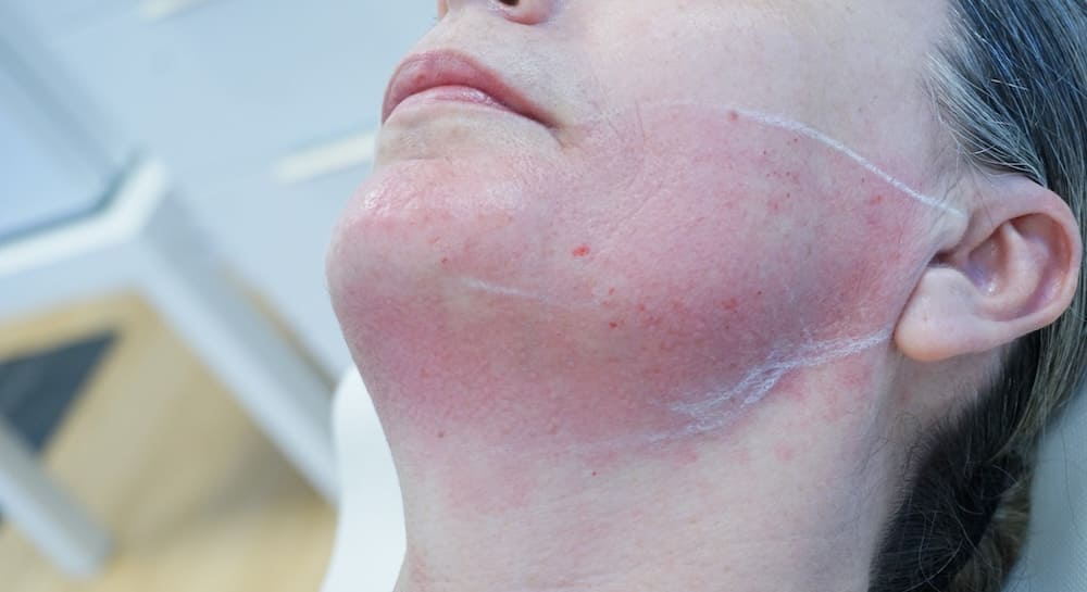 RAFFERMISSEMENT PEAU_CLEM VANNES raffermissement de la peau avec Morpheus 8 chez CLEM Vannes