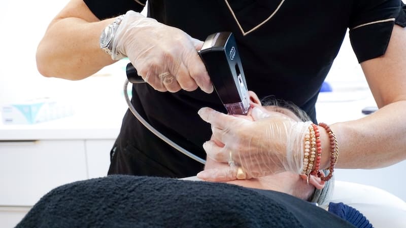TRAITEMENT RADIOFRÉQUENCES_CLEM B_VANNES traitement par radiofréquences et microneedling chez CLEM Vannes