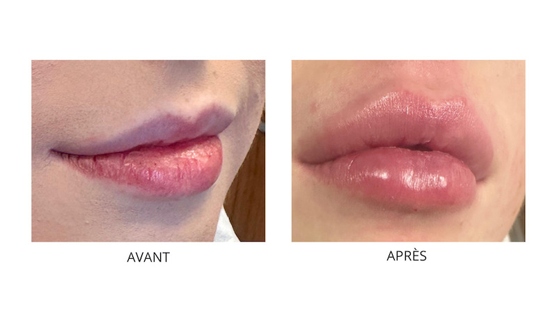 INJECTION ACIDE HYALURONIQUE VANNES INJECTION ACIDE HYALURONIQUE chez CLEM à VANNES