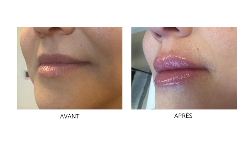 INJECTION LEVRES ACIDE HYALURONIQUE MORBIHAN INJECTION LEVRES ACIDE HYALURONIQUE MORBIHAN Chez CLEM VANNES