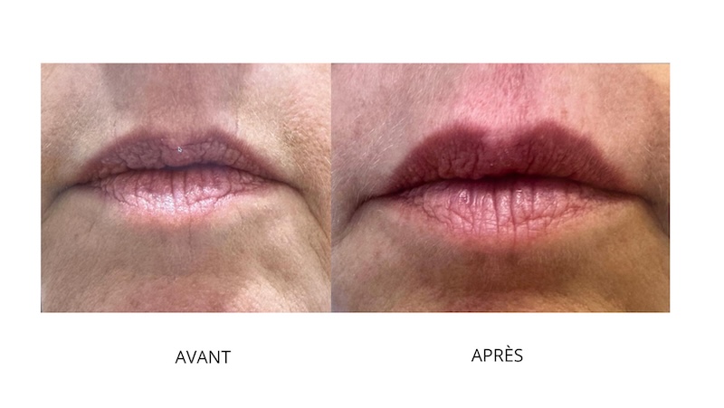 injections acide hyaluronique rides péribucales injections acide hyaluronique rides péribucales-clem vannes