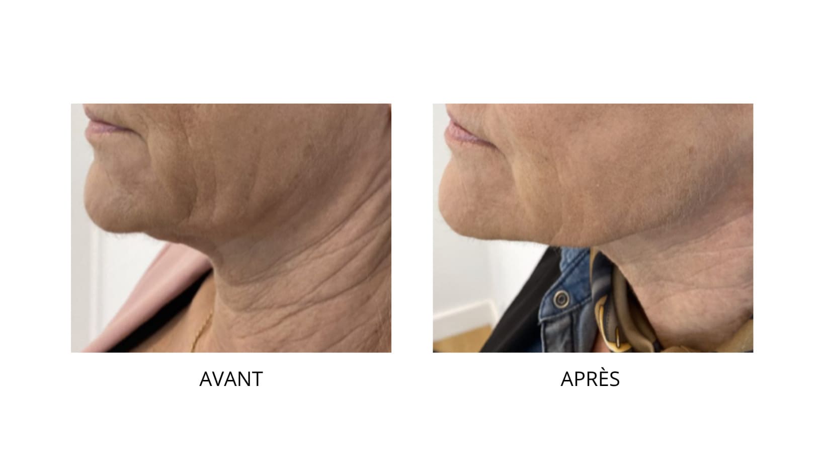 Pose de fils tenseurs chez CLEM à Vannes (56)