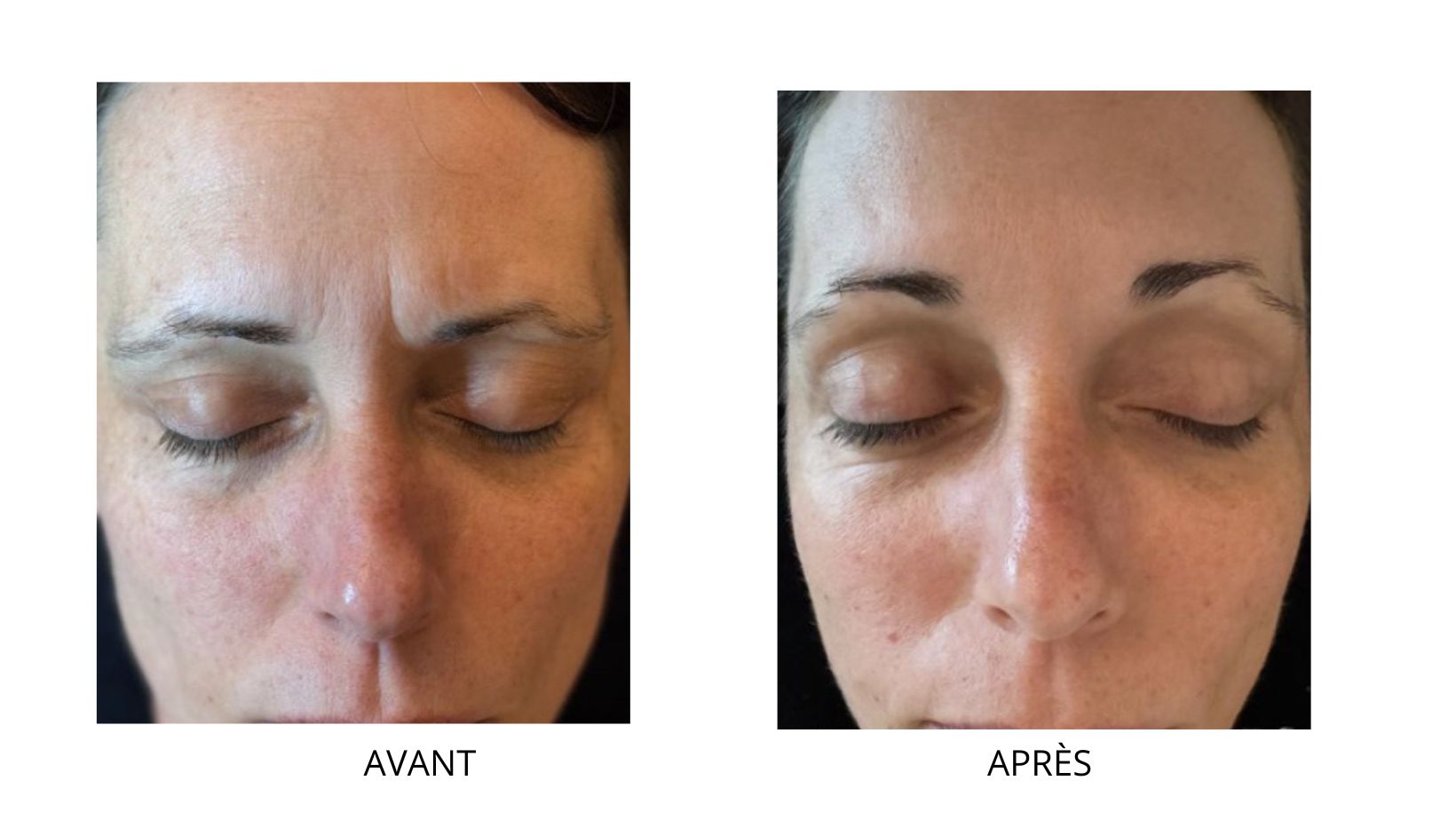 Bénéfices Kobido du visage chez CLEM Vannes