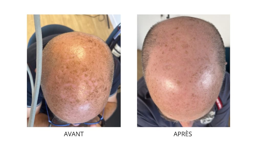 Résultat d'un peeling chez CLEM Vannes