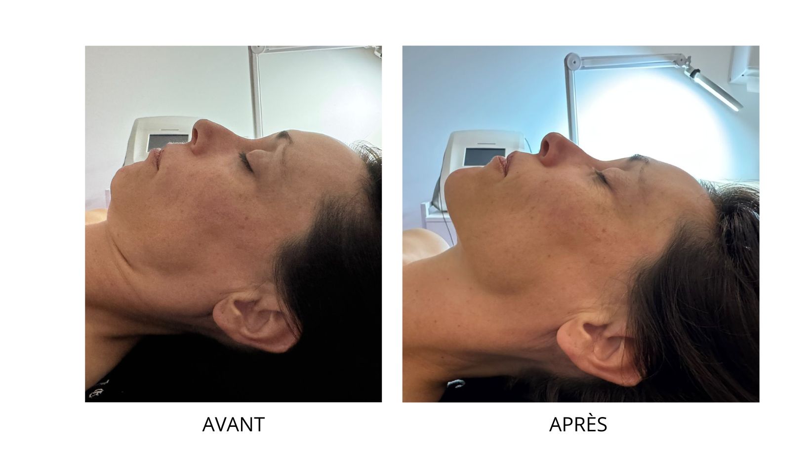 Résultats Kobido de la jawline - CLEM Vannes