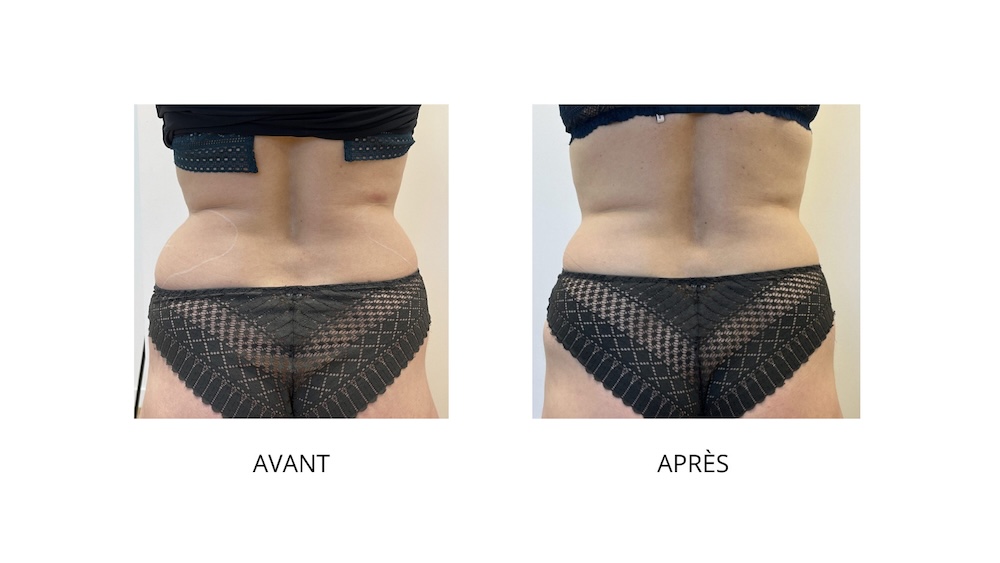 Photos Avant Après d'une cryolipolyse des hanches