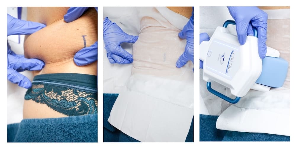 Les étapes d'une séance de cryolipolyse