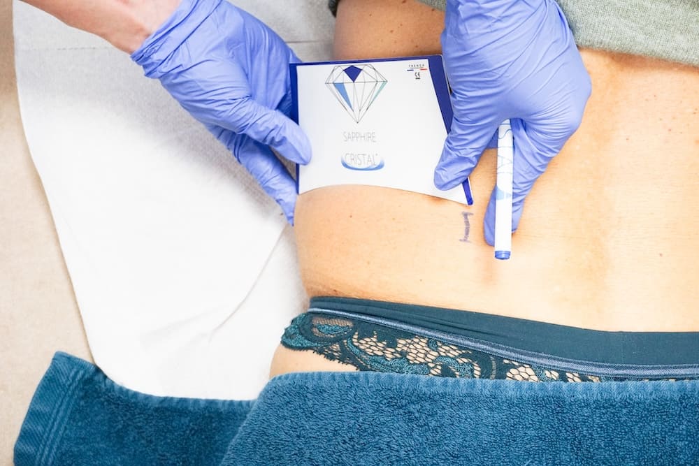 Cryolipolyse des hanches à CLEM Vannes