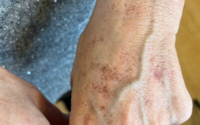 Comment rajeunir les mains en corrigeant volume, peau et taches grâce à la médecine esthétique