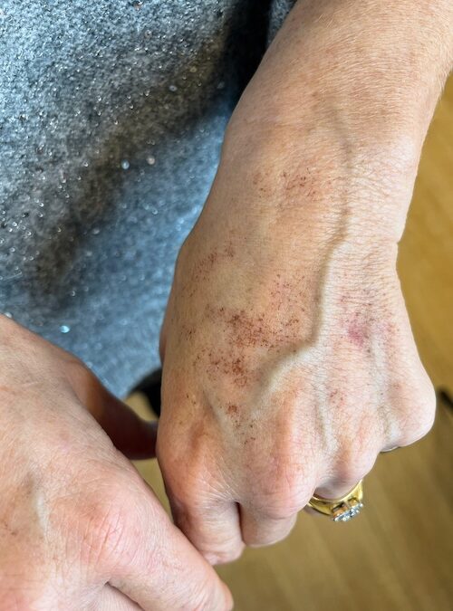 Comment rajeunir les mains en corrigeant volume, peau et taches grâce à la médecine esthétique