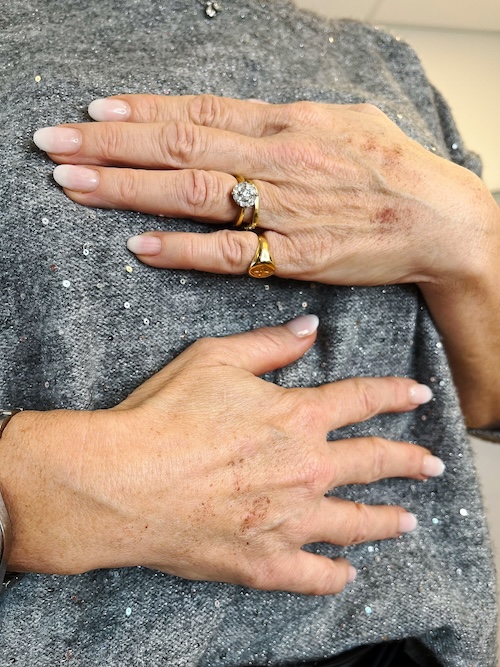 soins anti age acide hyaluronique jeunesse mains vannes 2