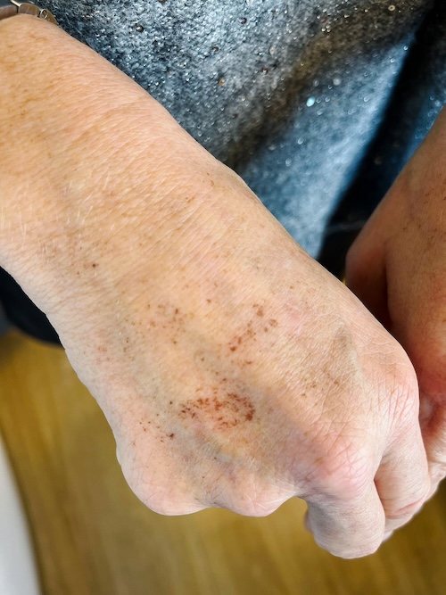 soins anti age acide hyaluronique jeunesse mains vannes