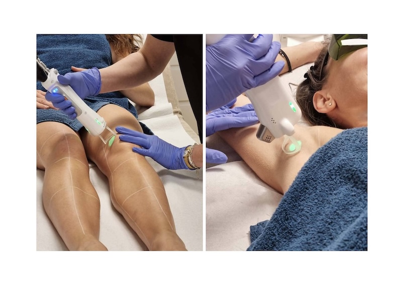 épilation laser chez Clem de Vannes