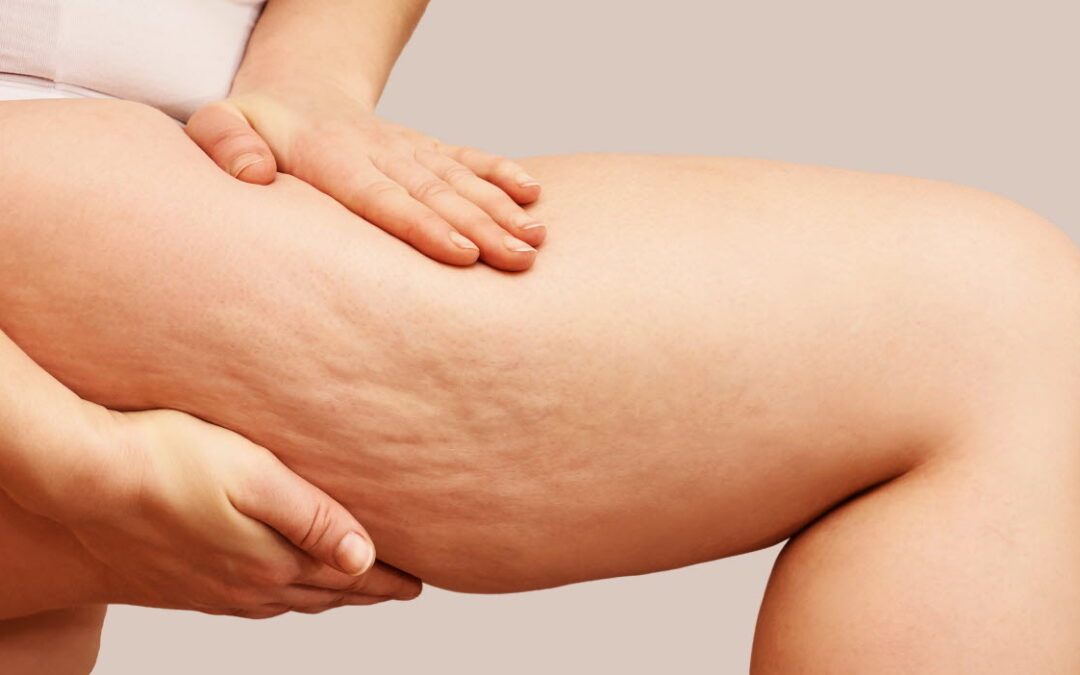 Traitement de la cellulite à Vannes : quelles solutions efficaces ?