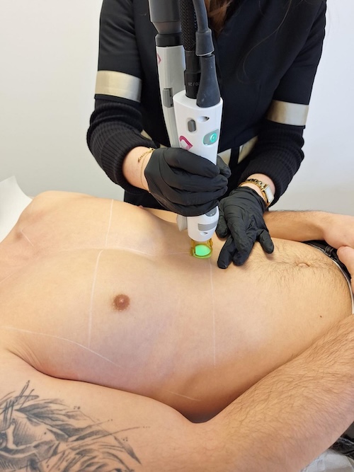 épilation laser hommes Lorient